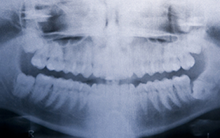 Experto en Ortodoncia Funcional, Aparatologia fija estética y alineadores